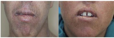 Identification of a ERCC5 c.2333T>C (L778P) Variant in Two Tunisian Siblings With Mild <mark class="highlighted">Xeroderma</mark> Pigmentosum Phenotype